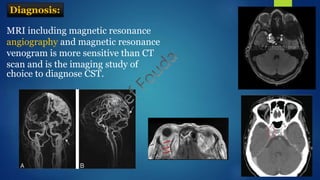 MRI including magnetic resonance
angiography and magnetic resonance
venogram is more sensitive than CT
scan and is the imaging study of
choice to diagnose CST.
Diagnosis:
 