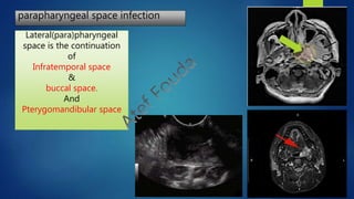 parapharyngeal space infection
Lateral(para)pharyngeal
space is the continuation
of
Infratemporal space
&
buccal space.
And
Pterygomandibular space
 