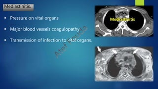 Mediastinitis.
 Pressure on vital organs.
 Major blood vessels coagulopathy.
 Transmission of infection to vital organs.
 