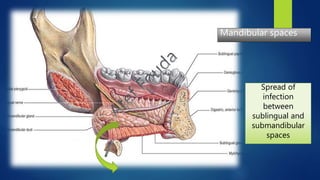 Mandibular spaces
Spread of
infection
between
sublingual and
submandibular
spaces
 