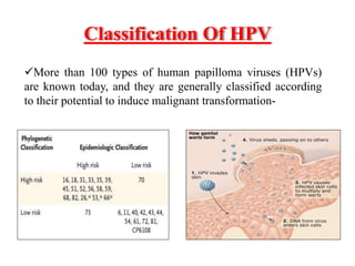 Classification Of HPV
More than 100 types of human papilloma viruses (HPVs)
are known today, and they are generally classified according
to their potential to induce malignant transformation-
 