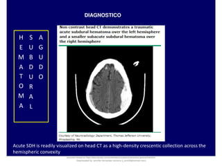 DIAGNOSTICO
H
E
M
A
T
O
M
A
S
U
B
D
U
R
A
L
A
G
U
D
O
Acute SDH is readily visualized on head CT as a high-density crescentic collection across the
hemispheric convexity
Document shared on https://www.docsity.com/es/hematoma-subdural-panorama-general/5322403/
Downloaded by: jennifer-fernandez-vizcarra (j_enn29@hotmail.com)
 