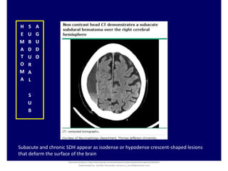 H
E
M
A
T
O
M
A
S
U
B
D
U
R
A
L
S
U
B
A
G
U
D
O
Subacute and chronic SDH appear as isodense or hypodense crescent-shaped lesions
that deform the surface of the brain
Document shared on https://www.docsity.com/es/hematoma-subdural-panorama-general/5322403/
Downloaded by: jennifer-fernandez-vizcarra (j_enn29@hotmail.com)
 