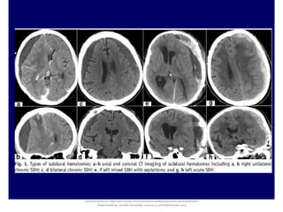 Document shared on https://www.docsity.com/es/hematoma-subdural-panorama-general/5322403/
Downloaded by: jennifer-fernandez-vizcarra (j_enn29@hotmail.com)
 