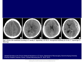 Multiple Densities of the Chronic Subdural Hematoma in CT Scans. Department of Neurosurgery, Soonchunhyang University
Cheonan Hospital, Cheonan, Korea. J Korean Neurosurg Soc 54 : 38-41, 2013
Document shared on https://www.docsity.com/es/hematoma-subdural-panorama-general/5322403/
Downloaded by: jennifer-fernandez-vizcarra (j_enn29@hotmail.com)
 