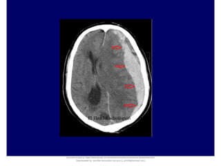 Document shared on https://www.docsity.com/es/hematoma-subdural-panorama-general/5322403/
Downloaded by: jennifer-fernandez-vizcarra (j_enn29@hotmail.com)
 