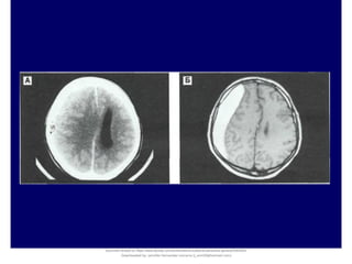Document shared on https://www.docsity.com/es/hematoma-subdural-panorama-general/5322403/
Downloaded by: jennifer-fernandez-vizcarra (j_enn29@hotmail.com)
 