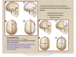 Document shared on https://www.docsity.com/es/hematoma-subdural-panorama-general/5322403/
Downloaded by: jennifer-fernandez-vizcarra (j_enn29@hotmail.com)
 