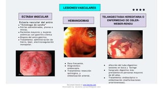 LESIONES VASCULARES
ECTASIA VASCULAR
HEMANGIOMAS
TELANGIECTASIA HEREDITARIA O
ENFERMEDAD DE OSLER-
WEBER-RENDU
Ectasia vascular del antro
● “Estómago de sandía”
● Estrías sobreelevadas, planas o
mixtas.
● Pacientes mayores y mujeres
anémicas con gastritis crónica
● Biopsia del antro gástrico.
● Tratamiento: administración de
hierro, láser, electrocoagulación
monopolar.
● Poco frecuente.
● Diagnóstico:
endoscopía.
● Tratamiento: resección
quirúrgica, y
embolización arterial.
●
●
Afección del tubo digestivo:
lesiones en boca y faringe
● Sangrado digestivo más
prevalente en personas mayores
de 60 años.
Tratamiento: endoscópico o
embolización (malformaciones
arteriovenosas).
Document shared on www.docsity.com
Downloaded by: JesusAriza (jariza2394@gmail.com)
 