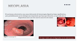 docsity-hemorragia-digestiva-64.pptx