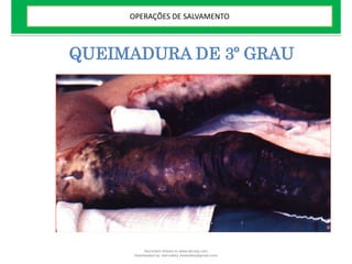 QUEIMADURA DE 3º GRAU
OPERAÇÕES DE SALVAMENTO
Document shared on www.docsity.com
Downloaded by: leal-safety (lealsafety@gmail.com)
 