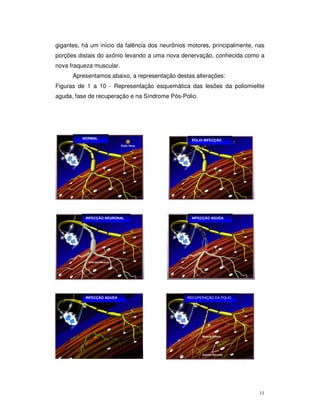 gigantes, há um início da falência dos neurônios motores, principalmente, nas
porções distais do axônio levando a uma nova denervação, conhecida como a
nova fraqueza muscular.
      Apresentamos abaixo, a representação destas alterações:
Figuras de 1 a 10 - Representação esquemática das lesões da poliomielite
aguda, fase de recuperação e na Síndrome Pós-Polio.




         NORMAL
                                                  POLIO INFECÇÃO




           INFECÇÃO NEURONAL                      INFECÇÃO AGUDA




           INFECÇÃO AGUDA                       RECUPERAÇÃO DA POLIO




                                                                           11
 