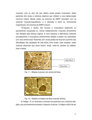 muscular, com ou sem dor que afetam certos grupos musculares. Estes
pacientes têm sinais e sintomas objetivos que refletem a nova deteorização
neuronal motora. Muitas vezes, os sintomas de AMPP coexistem com os
sintomas músculo-esqueléticos, e a distinção é difícil ou clinicamente
insignificante. Os sintomas de AMPP incluem:
      1)Fraqueza e atrofia: Isto envolve a musculatura totalmente ou
parcialmente recuperada ou, menos freqüentemente, músculos clinicamente
não afetados pela doença original. A nova fraqueza é assimétrica, afetando
principalmente a musculatura anteriormente afetada e podem ser associados
com nova atrofia focal. Pacientes com novas perdas de força tem aumento das
dificuldades das atividades da vida diária como andar, subir escadas, andar
mesmas distancias que antes faziam, dirigir, vestir-se, pentear os cabelos,
fazer a barba.




                                                                   Fibra Tipo II



                                                           Fibra Tipo I



           Fig. 11 – Biópsia muscular com atrofia de fibras




           Fig. 12 – Detalhe na biópsia de fibra muscular atrófica.
      2) Fadiga – É um fenômeno universal nos pacientes com síndrome pós-
pólio, que provavelmente precede a fraqueza muscular. A fadiga é difícil de ser




                                                                                   14
 