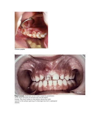 Chronic pulpitis
Pulpal necrosis. Darkened central incisor caused by penetration
of the tissue remnants of nonvital pulp into the dentin
tubules. The small nodule on the gingiva above the tooth
(parulis) is the surface opening of a drainage tract from a periapical
abscess.
 