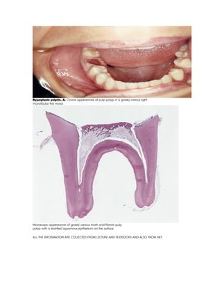 Hyperplastic pulpitis. A, Clinical appearance of pulp polyp in a grossly carious right
mandibular first molar
Microscopic appearance of grossly carious tooth and fibrotic pulp
polyp with a stratified squamous epithelium on the surface.
ALL THE INFORMATION ARE COLLECTED FROM LECTURE AND TEXTBOOKS AND ALSO FROM NET.
 