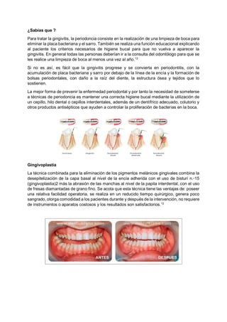¿Sabías que ?
Para tratar la gingivitis, la periodoncia consiste en la realización de una limpieza de boca para
eliminar la placa bacteriana y el sarro. También se realiza una función educacional explicando
al paciente los criterios necesarios de higiene bucal para que no vuelva a aparecer la
gingivitis. En general todas las personas deberían ir a la consulta del odontólogo para que se
les realice una limpieza de boca al menos una vez al año.12
Si no es así, es fácil que la gingivitis progrese y se convierta en periodontitis, con la
acumulación de placa bacteriana y sarro por debajo de la línea de la encía y la formación de
bolsas periodontales, con daño a la raíz del diente, la estructura ósea y tejidos que lo
sostienen.
La mejor forma de prevenir la enfermedad periodontal y por tanto la necesidad de someterse
a técnicas de periodoncia es mantener una correcta higiene bucal mediante la utilización de
un cepillo, hilo dental o cepillos interdentales, además de un dentífrico adecuado, colutorio y
otros productos antisépticos que ayuden a controlar la proliferación de bacterias en la boca.
Gingivoplastia
La técnica combinada para la eliminación de los pigmentos melánicos gingivales combina la
desepitelización de la capa basal al nivel de la encía adherida con el uso de bisturí n.◦15
(gingivoplastia)2 más la abrasión de las manchas al nivel de la papila interdental, con el uso
de fresas diamantadas de grano fino. Se acota que esta técnica tiene las ventajas de: poseer
una relativa facilidad operatoria, se realiza en un reducido tiempo quirúrgico, genera poco
sangrado, otorga comodidad a los pacientes durante y después de la intervención, no requiere
de instrumentos o aparatos costosos y los resultados son satisfactorios.12
 