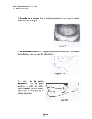 ADAPTACION DE RODETES DE CERA
Dra. NANCY CERVANTES
3.-Ecuador de la lengua. Que el rodete inferior al recortarlo no sobre pase
el ecuador de la lengua.
4.-Nivel del labio inferior. El rodete inferior deberá recortarse 2 milímetros
por debajo de este o a nivel del labio inferior.
5.- Nivel de la papila
retromolar. En la parte
posterior o distal del rodete
inferior deberá de recortarse a
dos tercios de recorrido de la
papila retromolar.
Página
13
 