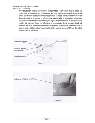 ADAPTACION DE RODETES DE CERA
Dra. NANCY CERVANTES
anterosuperior existan socavados exagerados (ver figura 10) la base se
observara antiestética en el paciente ya que protruirá exageradamente el
labio, por lo que adelgazaremos recortando la base en la parte bucal en el
área de canino a canino y si es muy exagerado el socavado podemos
realizar una ventana en el acrilico(ver figura 11) eliminando el acrílico de la
región de caninos (esto no afectara el procesado de la protesis total) el
objetivo de esto es observar como cae el labio superior de forma natural y
que se vea estético, observaremos también que se forme el filtrum del labio
superior en el paciente.
Página 7
 