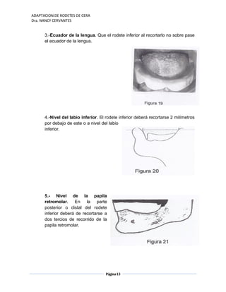 ADAPTACION DE RODETES DE CERA
Dra. NANCY CERVANTES
Página13
3.-Ecuador de la lengua. Que el rodete inferior al recortarlo no sobre pase
el ecuador de la lengua.
4.-Nivel del labio inferior. El rodete inferior deberá recortarse 2 milímetros
por debajo de este o a nivel del labio
inferior.
5.- Nivel de la papila
retromolar. En la parte
posterior o distal del rodete
inferior deberá de recortarse a
dos tercios de recorrido de la
papila retromolar.
 