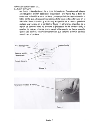 ADAPTACION DE RODETES DE CERA
Dra. NANCY CERVANTES
Página 7
gel, luego colocarla dentro de la boca del paciente. Cuando en el reborde
anterosuperior existan socavados exagerados (ver figura 10) la base se
observara antiestética en el paciente, ya que protruirá exageradamente el
labio, por lo que adelgazaremos recortando la base en la parte bucal en el
área de canino a canino y si es muy exagerado el socavado podemos
realizar una ventana en el acrílico(ver figura 11) eliminando el acrílico de la
región de caninos (esto no afectara el procesado de la prótesis total) el
objetivo de esto es observar como cae el labio superior de forma natural y
que se vea estético, observaremos también que se forme el filtrum del labio
superior en el paciente.
 