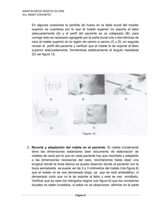 ADAPTACION DE RODETES DE CERA
Dra. NANCY CERVANTES
Página 8
En algunas ocasiones la perdida de hueso en la tabla bucal del maxilar
superior es cuantiosa por lo que al rodete superior no soporta el labio
adecuadamente (A) y el perfil del paciente se ve colapsado (B), para
corregir esto es necesario agregarle por la parte bucal una o dos láminas de
cera al rodete superior en la región de canino a canino (C y D), en seguida
revisar el perfil del paciente y verificar que el rodete le de soporte al labio
superior adecuadamente, formándose estéticamente el ángulo nasolabial
(E) ver figura 12.
2. Recorte y adaptación del rodete en el paciente: El rodete inicialmente
tiene las dimensiones estándares (leer documento de elaboración de
rodetes de cera) por lo que en cada paciente hay que recortarlo y adaptarlo
a las dimensiones necesarias del caso, recortaremos hasta dejar una
longitud donde la línea blanca se pueda observar donde el paciente con la
boca semiabierta se pueda ver de 2 a 3 milímetros del rodete (Ver figura 6)
que el rodete no se vea demasiado largo, ya que se verá antiestético, ni
demasiado corto que no le de soporte al labio y este se vea enrollado.
Verificar que se vean los triángulos negros (ver figura 9) que los corredores
bucales no estén invadidos, si estos no se observaran, eliminar en la parte
 