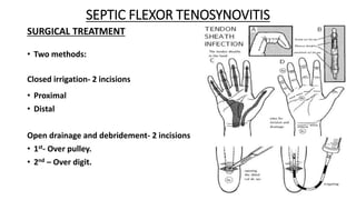 Racket Incision Digits documents_null-ANATOMY+OF+HAND+SPACE,+INFECTIONS+OF+HAND (2).pdf