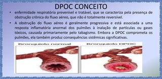 DPOC CONCEITO
• enfermidade respiratória prevenível e tratável, que se caracteriza pela presença de
obstrução crônica do fluxo aéreo, que não é totalmente reversível.
• A obstrução do fluxo aéreo é geralmente progressiva e está associada a uma
resposta inflamatória anormal dos pulmões à inalação de partículas ou gases
tóxicos, causada primariamente pelo tabagismo. Embora a DPOC comprometa os
pulmões, ela também produz consequências sistêmicas significativas.
 