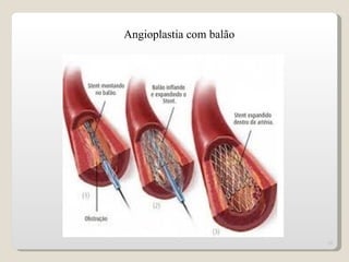 Angioplastia com balão




                         15
 