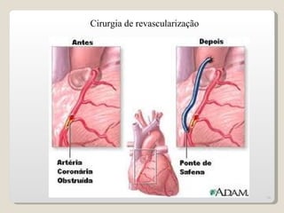 Cirurgia de revascularização




                               16
 