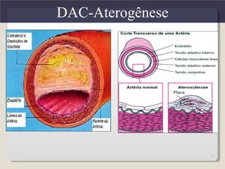 DAC-Aterogênese




                  17
 