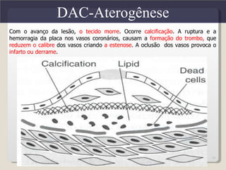 DAC-Aterogênese
Com o avanço da lesão, o tecido morre. Ocorre calcificação. A ruptura e a
hemorragia da placa nos vasos coronários, causam a formação do trombo, que
reduzem o calibre dos vasos criando a estenose. A oclusão dos vasos provoca o
infarto ou derrame.




                                                                           26
 