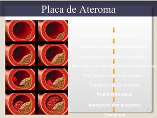 Placa de Ateroma
            Acumulo de lipídios modificados

         Ativação das células endoteliais

          Migração das células inflamatórias

          Ativação das células inflamatórias

      Recrutamento das células musculares lisas

           Proliferação e síntese da matriz

              Formação da capa fibrosa

                  Ruptura da placa

             Agregação das plaquetas
                                               28

                      Trombose
 