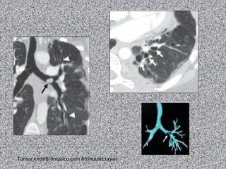Tumor endobrônquico com bronquiectasias
 