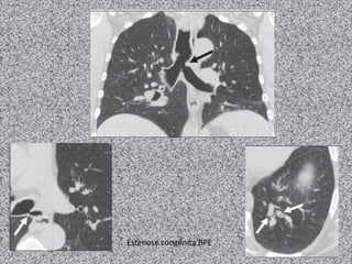 Estenose congênita BPE
 