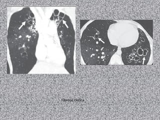 Fibrose cística
 