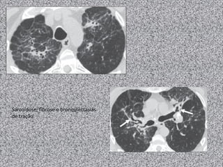 Sarcoidose: fibrose e bronquiectasias
de tração.
 