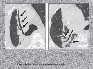 Pós irradiação: fibrose e bronquiectasias de tração
 