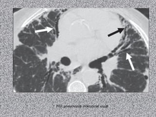 PIU: pneumonia intersticial usual
 