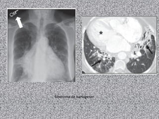 Síndrome de Kartagener
 