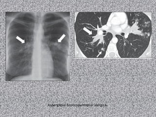 Aspergilose broncopulmonar alérgica
 