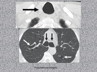 Traqueobroncomegalia
 