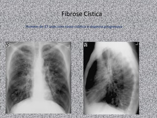 Fibrose Cística
Homem de 37 anos com tosse crônica e dispneia progressiva
 