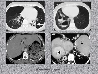 Síndrome de Kartagener
 
