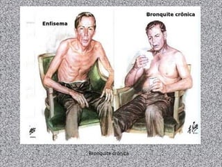 Bronquite crônica
 