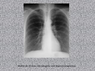 Mulher de 20 anos, não tabagista com dispneia progressiva.
 