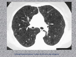 Linfangioleiomiomatose: mulher de 20 anos não tabagista.
 