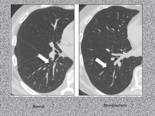 Normal   Bronquiectasia
 
