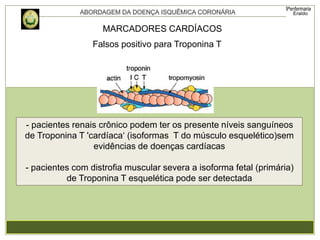 - pacientes renais crônico podem ter os presente níveis sanguíneos
de Troponina T 'cardíaca‘ (isoformas T do músculo esquelético)sem
evidências de doenças cardíacas
- pacientes com distrofia muscular severa a isoforma fetal (primária)
de Troponina T esquelética pode ser detectada
Falsos positivo para Troponina T
MARCADORES CARDÍACOS
 