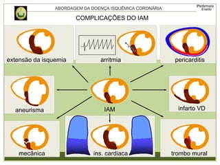 trombo mural
extensão da isquemia
IAM
arritmia
ins. cardiaca
aneurisma infarto VD
pericarditis
mecânica
COMPLICAÇÕES DO IAM
 