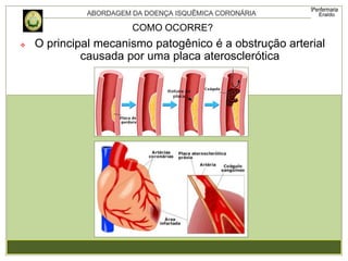 COMO OCORRE?
 O principal mecanismo patogênico é a obstrução arterial
causada por uma placa aterosclerótica
 